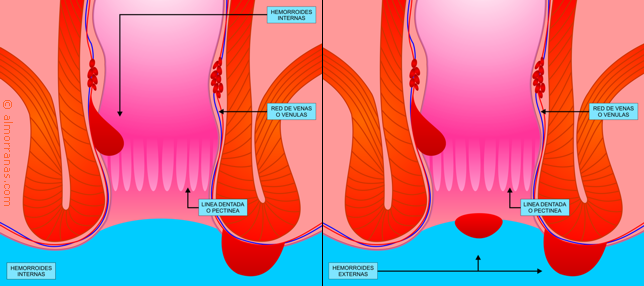 Almorranas