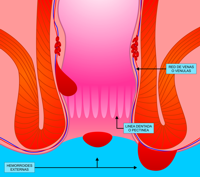 hemorroides externas