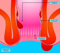 hemorroides internas