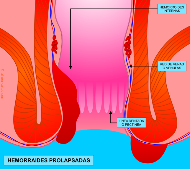 Hemorroides Prolapsadas