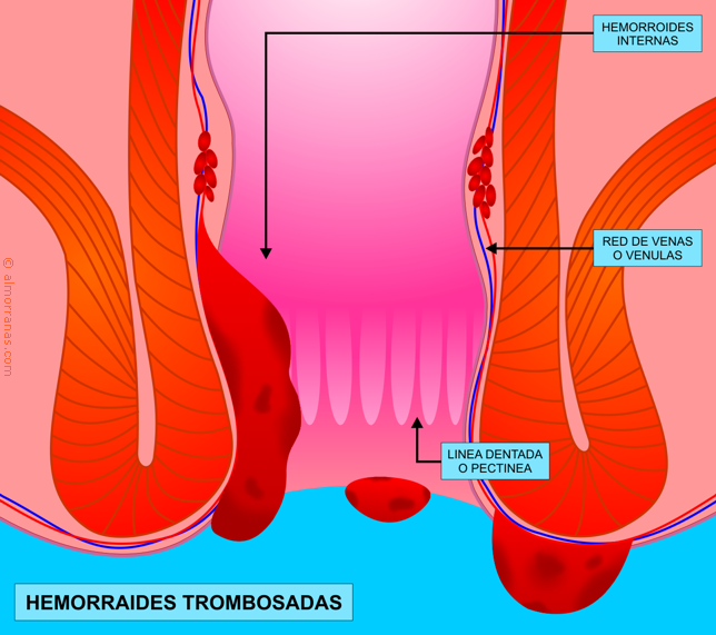 Hemorroides Trombosadas